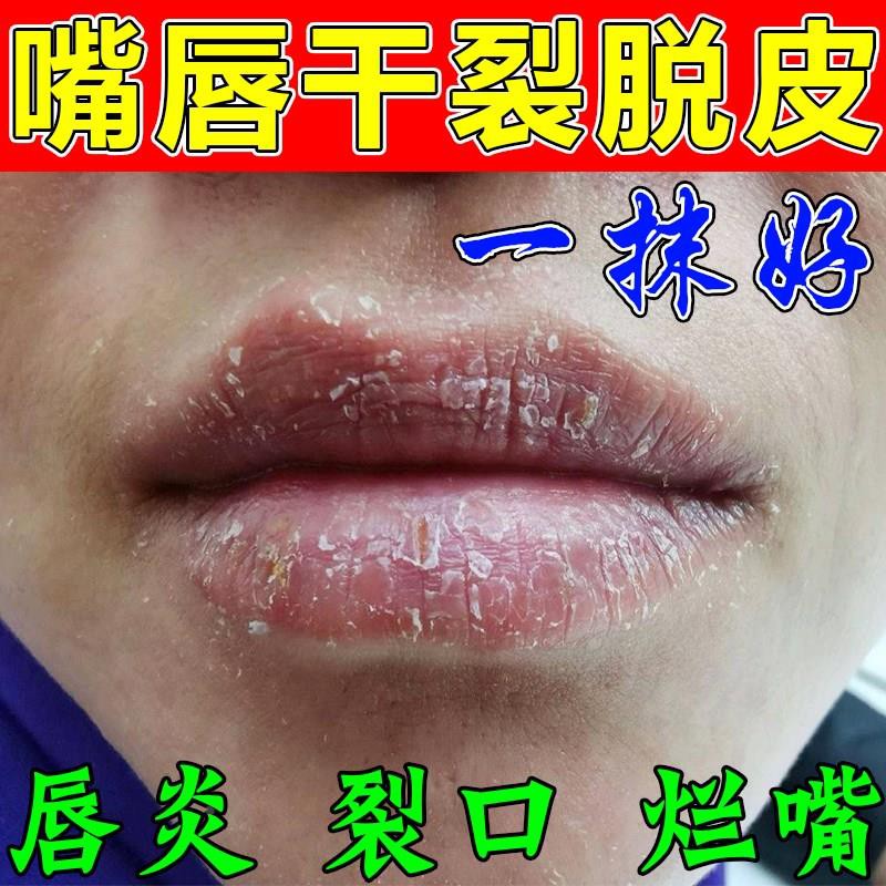 唇炎专用唇膏修复嘴唇干裂脱皮药润唇膏烂嘴角干燥起皮裂口起死皮