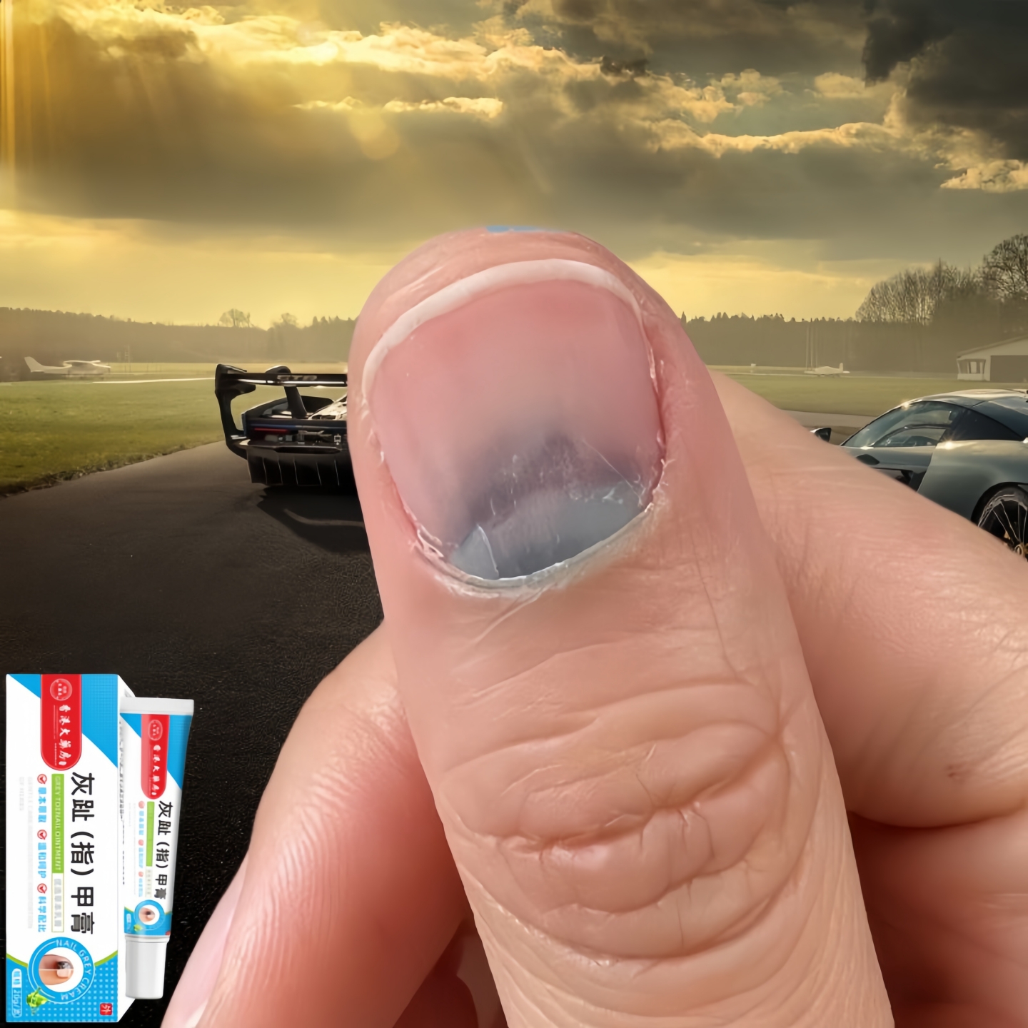 指甲有大面积黑色淤血指甲疼痛甲床分离真菌感染快速修复