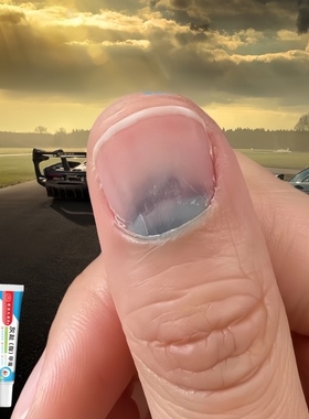 指甲有大面积黑色淤血指甲疼痛甲床分离真菌感染快速修复