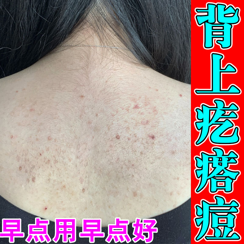 身上起红肿痘皮肤小红点背上有小皮肤消毒护理（消）
