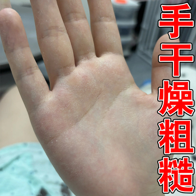 手指头干裂手裂口起皮掉屑修护霜去死皮用