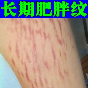去肥胖纹修复霜生长纹消除大腿学生肥胖生长纹精油防止复发修复膏