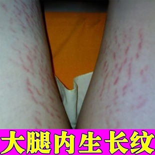 去肥胖纹修复霜生长纹消除大腿学生屁股淡化去除男精油青少年膏