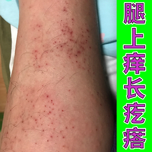 小腿皮肤痒起红点疙瘩换季腿部发痒长藓起疹子皮肤过敏湿痒专用膏