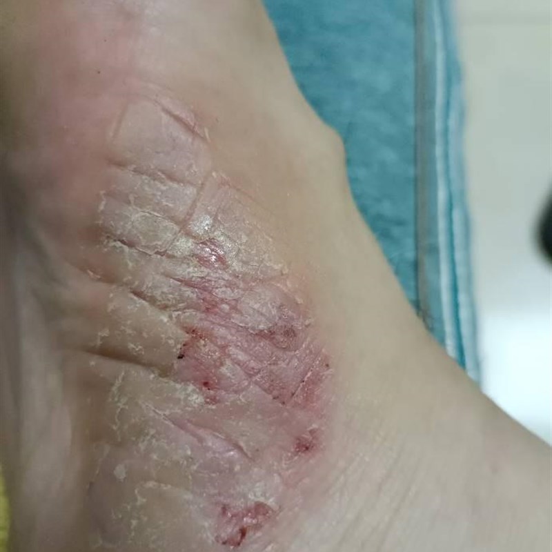 现货治烂脚丫菌脚头掉皮脱糜烂皮水1趾泡止痒真气脚手足痒去除