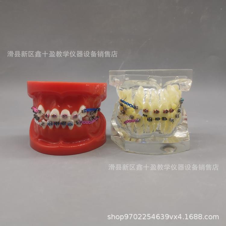 牙齿正畸模型缺失牙错颌牙列不齐矫正金属托槽带支抗牵引皮拉链