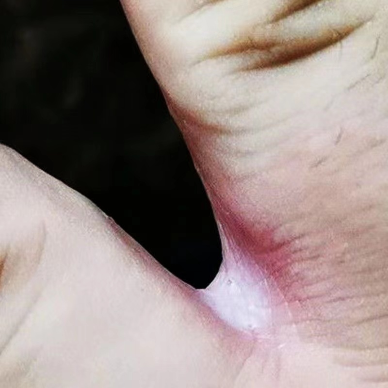 手指缝溃烂烂手丫药溃烂手指手烂药膏手指溃烂发红脱皮瘙痒手丫烂