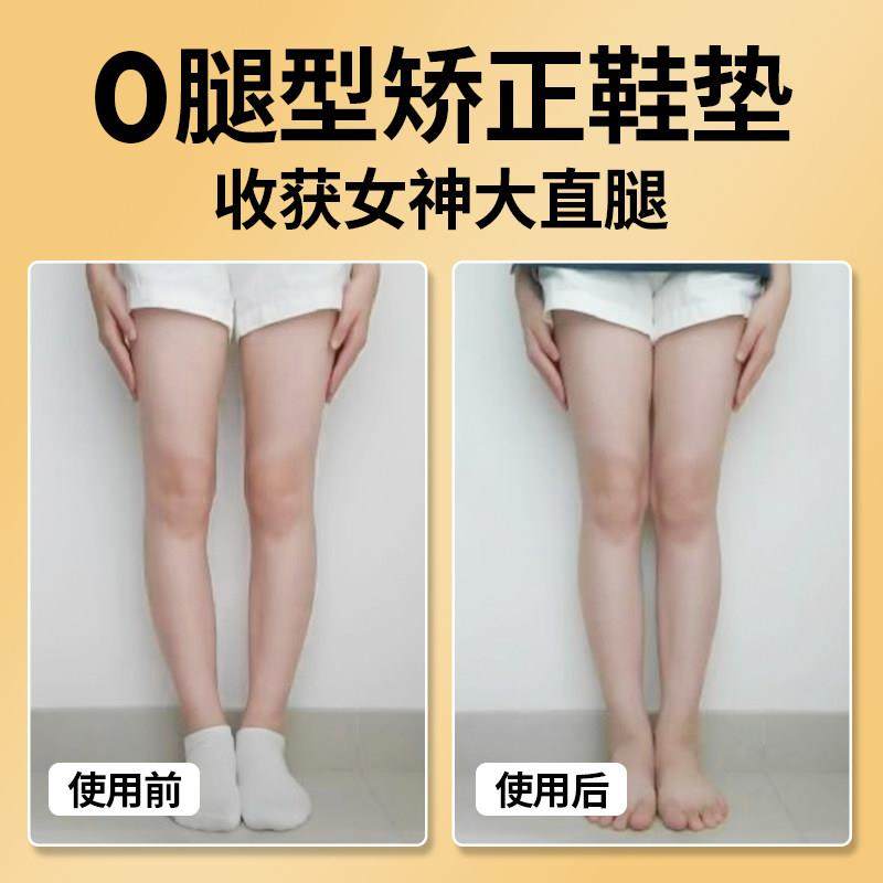 成人直腿神器o型X型小腿外翻矫正鞋垫扁平足弓支撑垫鞋防止鞋底磨