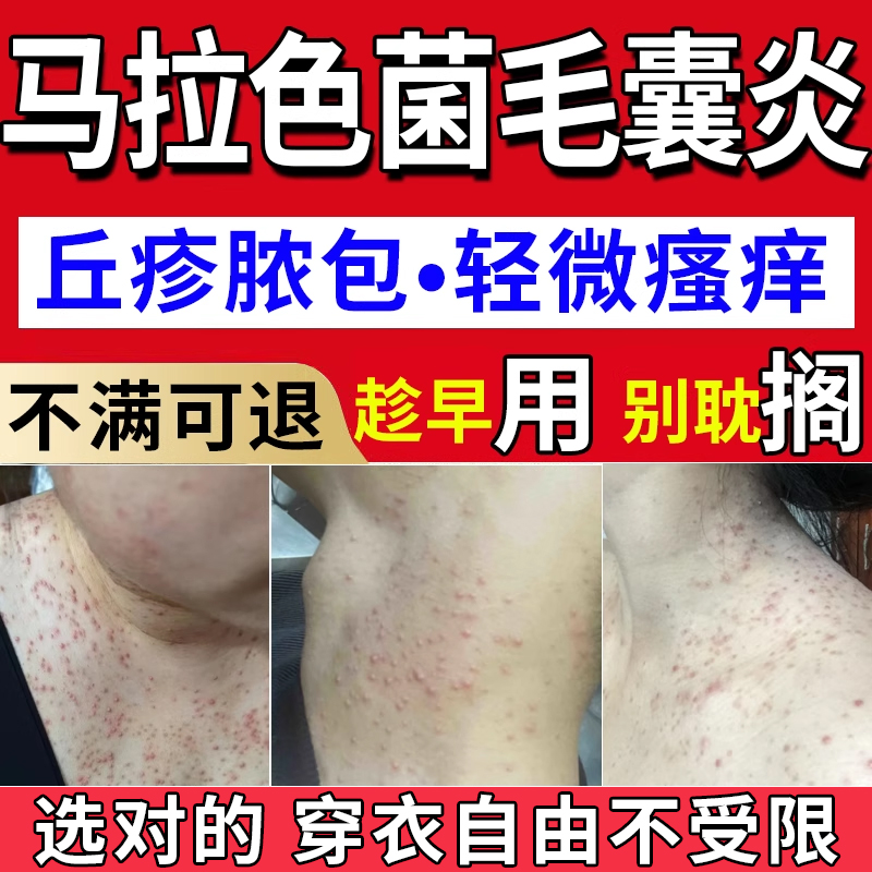 马拉色菌毛囊炎前胸后背颈瘙痒祛痘丘疹