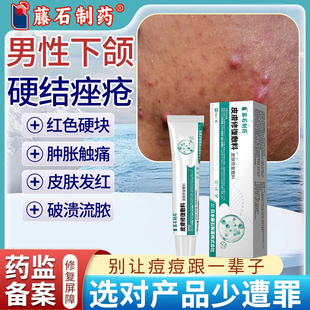 男性下颌硬结痤疮青春痘粉刺闭口玫瑰痤疮痘印屏障修复泛红凸起RW