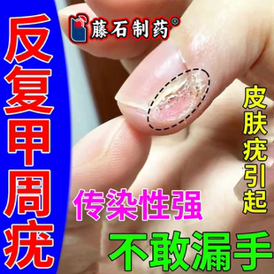 甲周疣专用去手指长疣儿童甲下旁长寻常疣去除神器疣瘊肉粒甲沟VZ