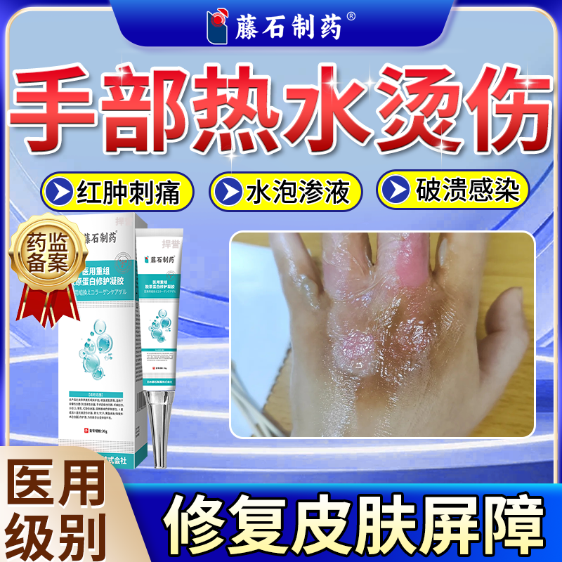 手部热水烫伤色素沉淀烧伤烫伤疤痕凝胶Q8