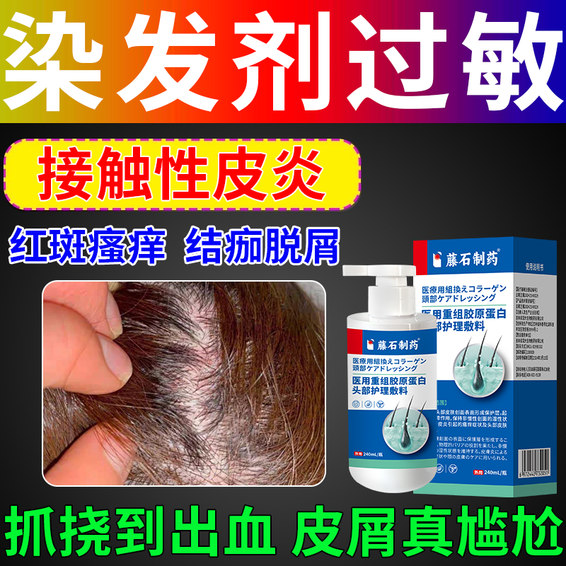 染发膏过敏接触性皮炎脂溢毛囊炎刺痛头皮痒红肿脖子起痘头皮屑RW