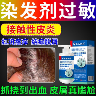 染发膏过敏接触性皮炎脂溢毛囊炎刺痛头皮痒红肿脖子起痘头皮屑RW