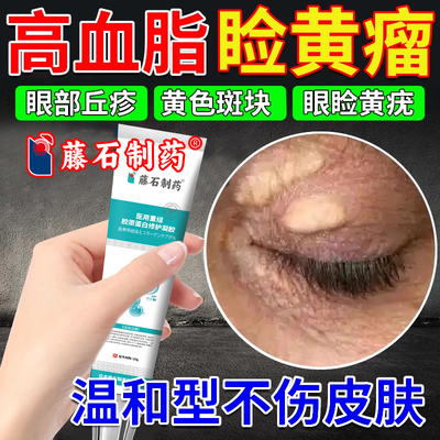 眼睑黄瘤膏眼角黄色疣黄斑去眼部脂肪粒眼角斑汗管瘤高血脂除RW