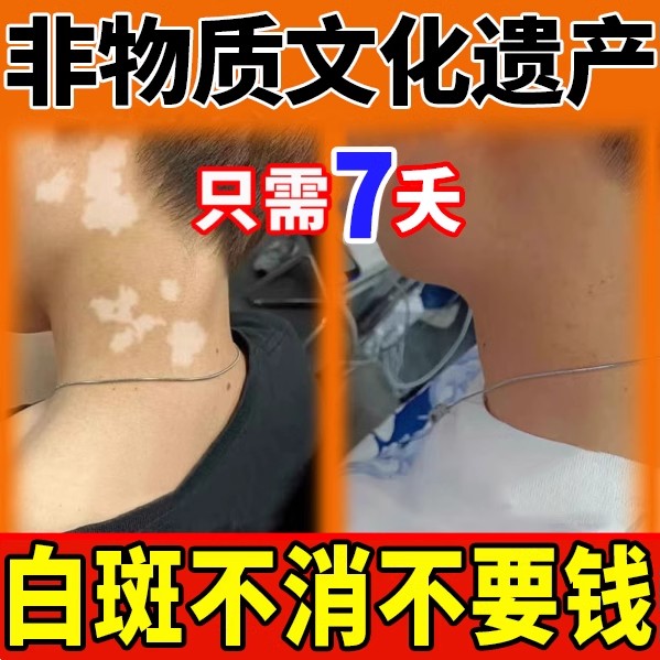 非遗传承！炮制药膏针对各种白斑