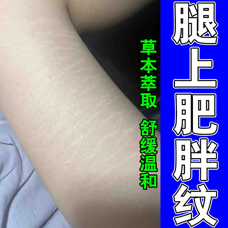 肥胖纹生长纹淡化大腿膝盖长横纹白纹修复淡化纹路植物修复膏