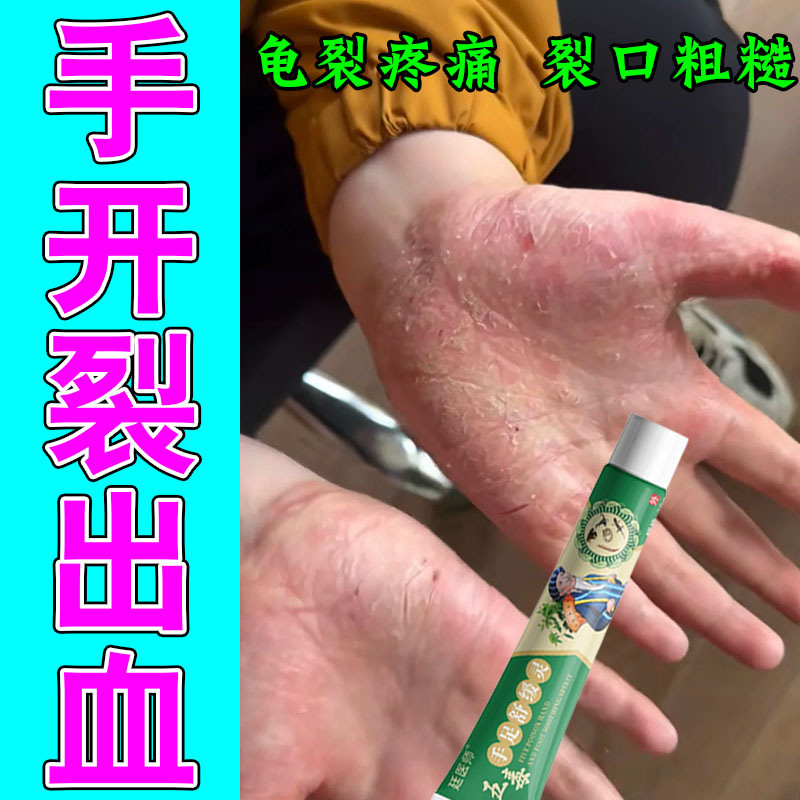手干裂口粗糙发痒季节性粗糙手部干燥起皮开裂口脱皮修护保湿膏
