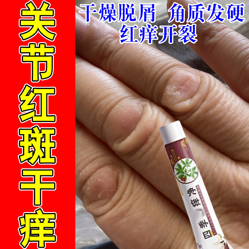 手指关节真菌指手指关节干裂痒指节膏指关节手指关节干燥屑发痒膏