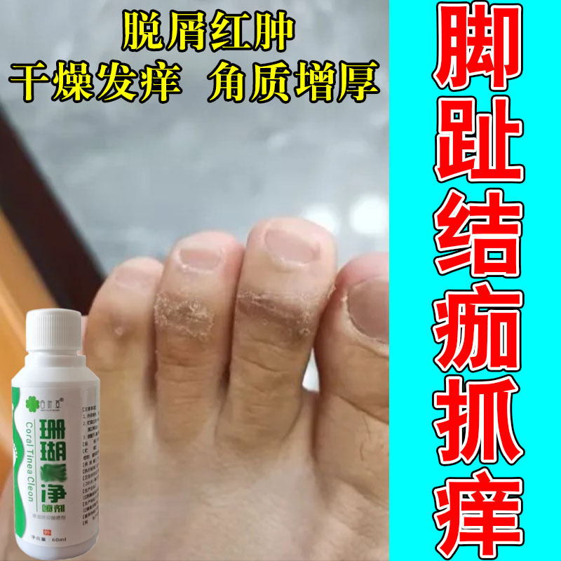 脚指头角质粗糙硬皮角化型起皮干燥红斑角质层厚草本修护乳膏