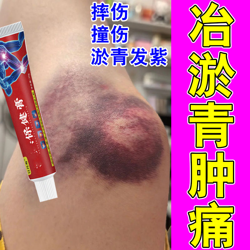 撞伤淤青明显发紫活血化瘀膝盖摔磕碰撞伤发紫红肿胀痛散淤外用膏