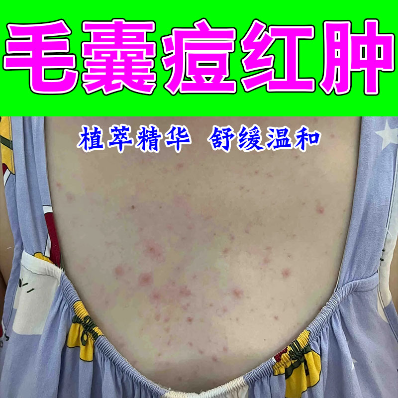 背上长痘毛囊疙瘩红肿疼马拉色菌前胸后背疙瘩修护植物膏乳
