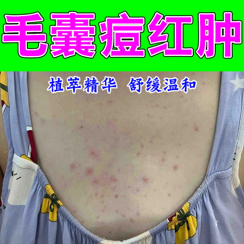 背上长痘毛囊疙瘩红肿疼马拉色菌前胸后背疙瘩修护植物膏乳