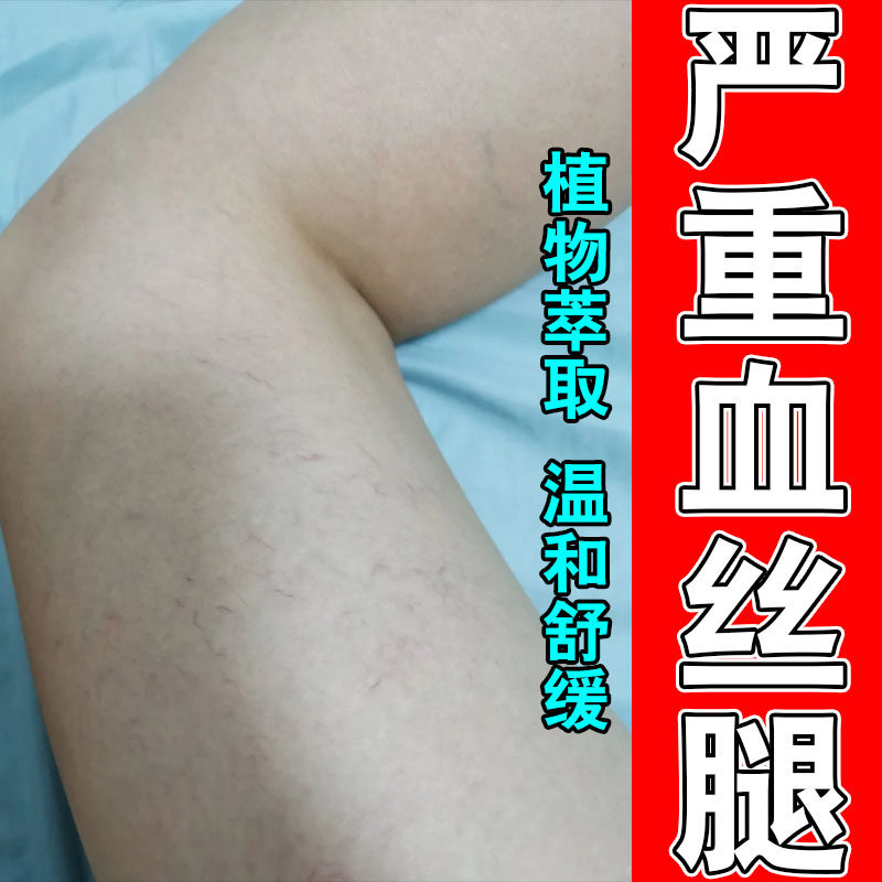 常年血丝腿毛细血管扩张舒缓小腿青筋凸起肿胀草本按摩乳膏