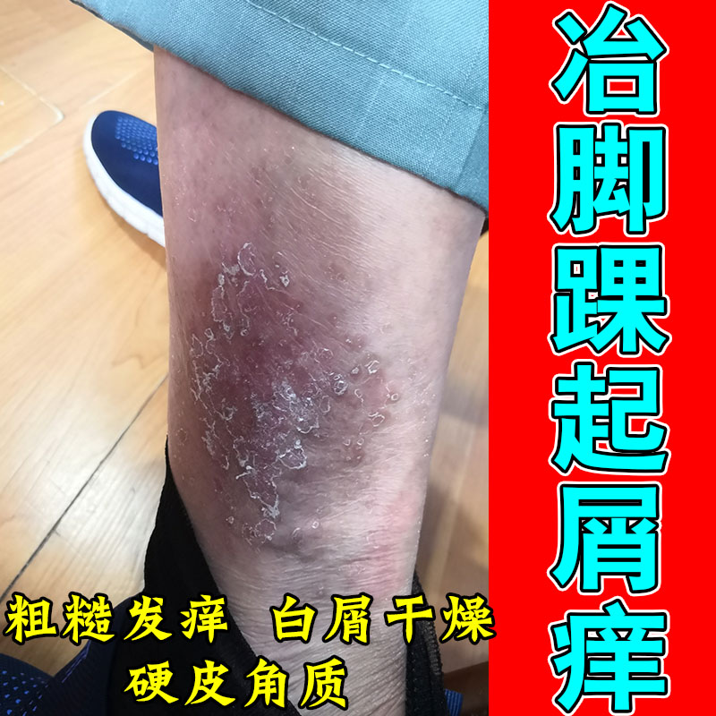 脚踝痒脚脖上长疙瘩痒起小疙瘩皮肤过敏红痒红斑粗糙草本修护乳膏