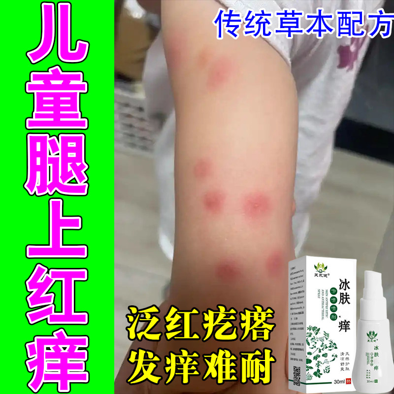 宝宝腿上疙瘩蚊虫叮咬四肢起红肿包胳膊腿疙瘩肿痒草本修护喷剂