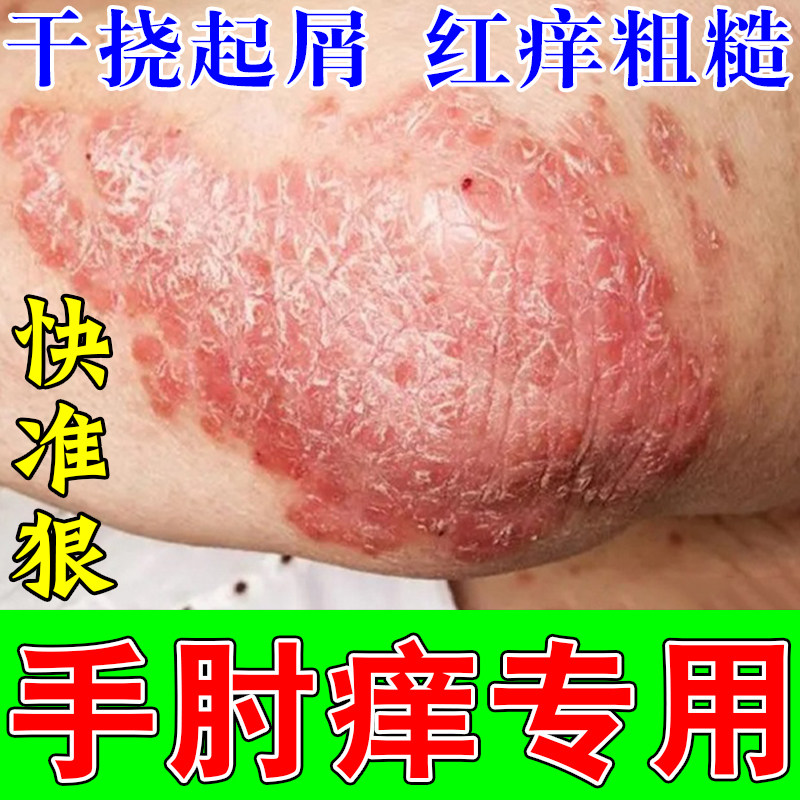 手肘痒红斑粗糙长红屑手起干皮开裂脱皮红过敏疙瘩皮肤红发乳膏