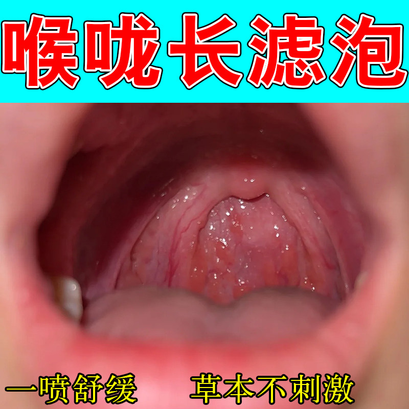 咽喉壁淋巴滤泡增生咽喉灼热异物感干疼喉咙草本舒缓干疼喷剂