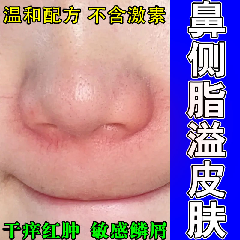 脂溢性鼻侧发红起干皮起屑脂溢性痒脂溢性鼻侧干燥泛红草本修护膏