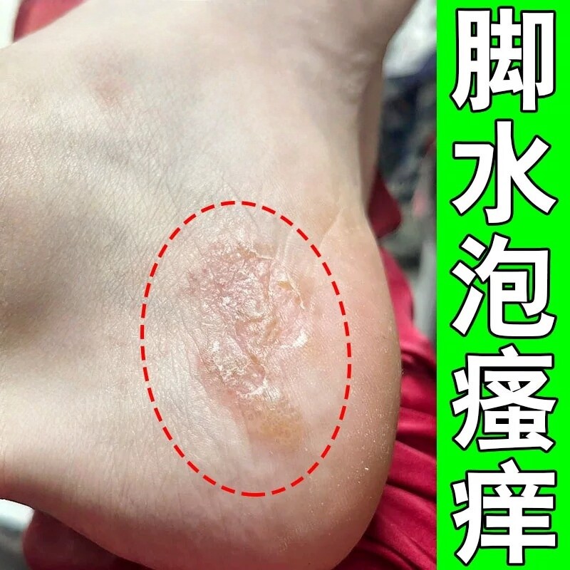 脚上起水泡脚上脱皮的膏脚底长小水泡脚丫痒脚难闻臭味脚趾缝