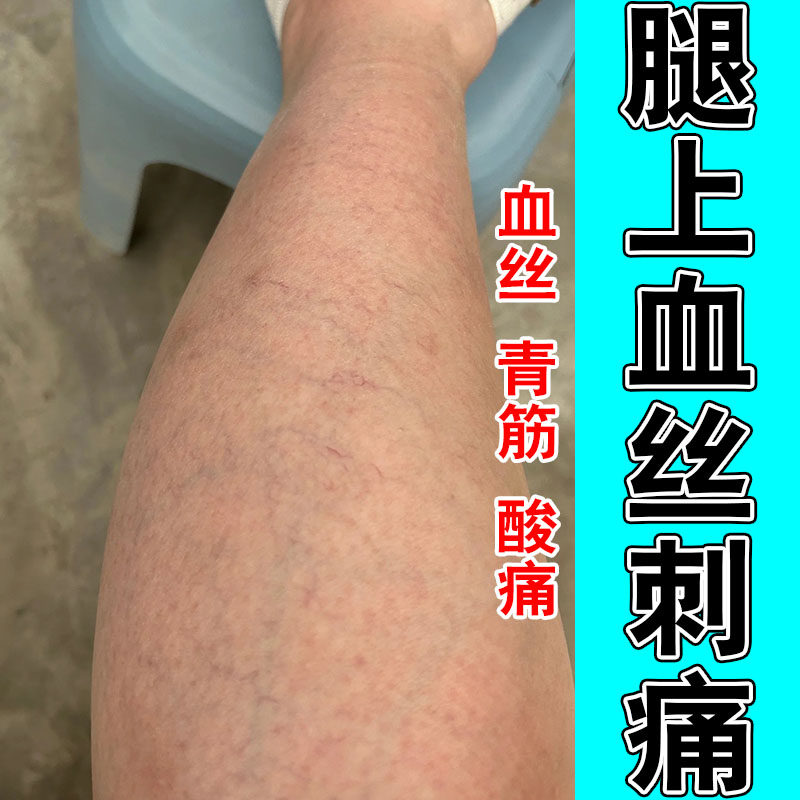 大腿小腿毛细血管扩张舒缓红血丝腿部酸胀肿痛草本修护膏