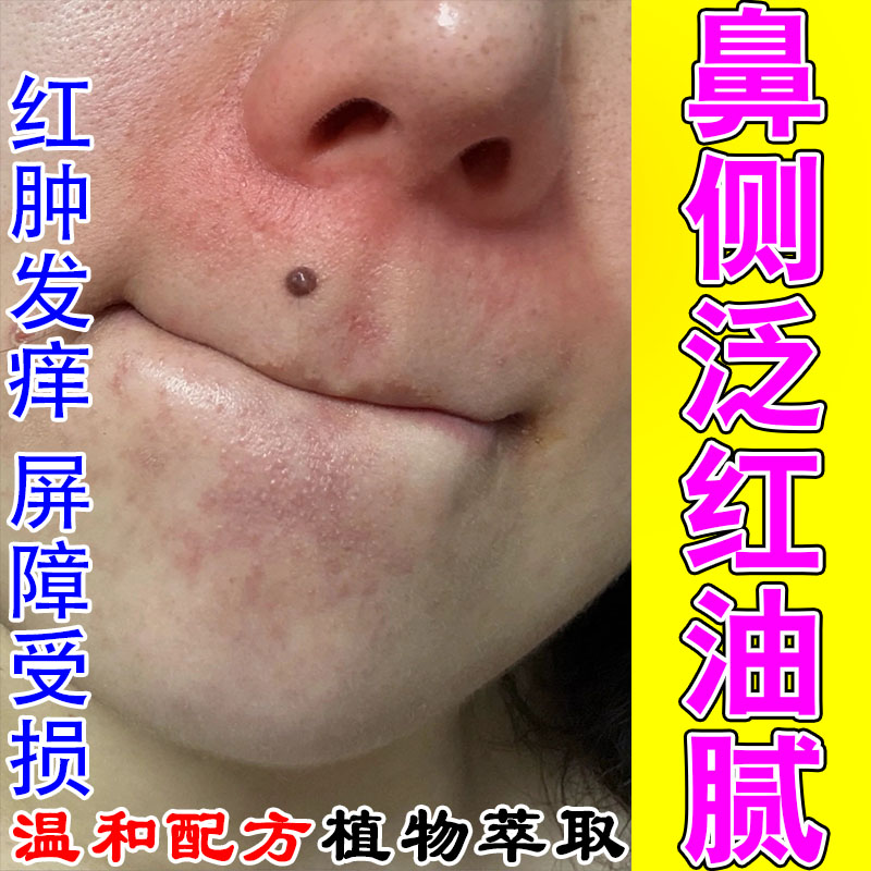 脂溢性鼻侧发红起皮鼻翼两边泛红干燥起皮掉皮痒鼻头红植物萃取膏
