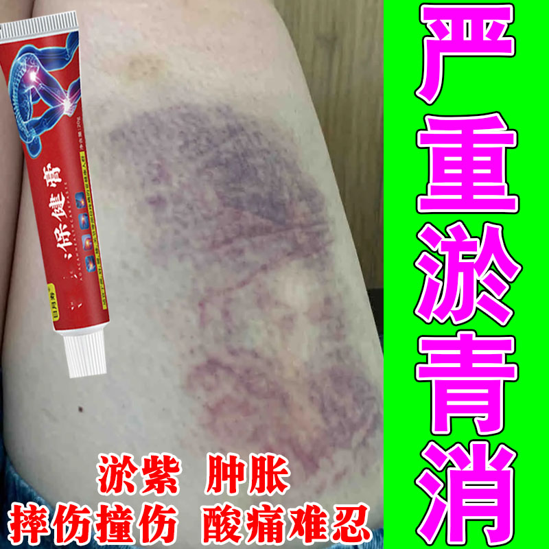 腿上淤青发紫活血化瘀儿童磕碰撞摔伤消肿痛散瘀成人淤青修护膏