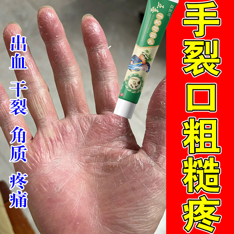 手掌干裂真菌蜕皮手上起皮干燥掉皮专用真菌掉皮手心开裂护手膏