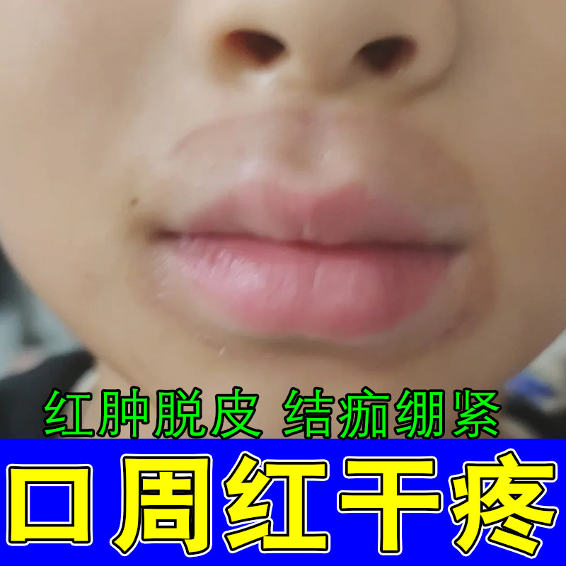 冶儿童嘴巴周围干红刺痛舔唇干燥疼引发口周干裂红肿肿疼修护膏