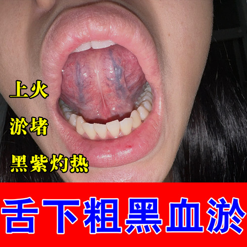 舌根肿痛舌下青筋粗黑淤堵舌底血管发紫扩张草本养护舒缓喷剂