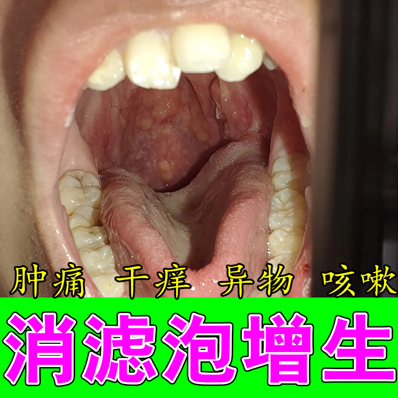 舌咽淋巴滤泡增生喉咙发红发热异物感咽喉修护水泡红肿喷剂