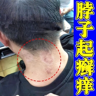 脖子上起皮颈部后面长疙瘩红痒刺挠神经性皮肤炎防紫外线过敏乳膏