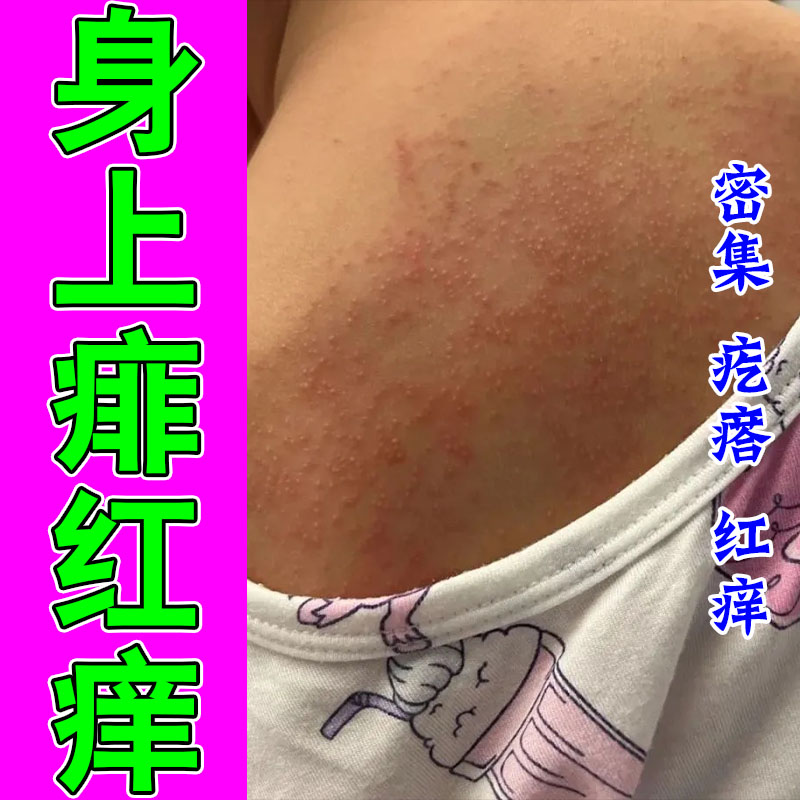 冶小孩身上痱子疙瘩红点身上发痒疙瘩大片密集植物修护喷剂