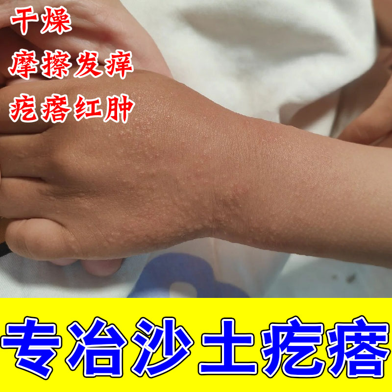 沙土刺激摩擦疙瘩紫外线过敏软膏修护手腕手痒细小疙瘩草本膏图片