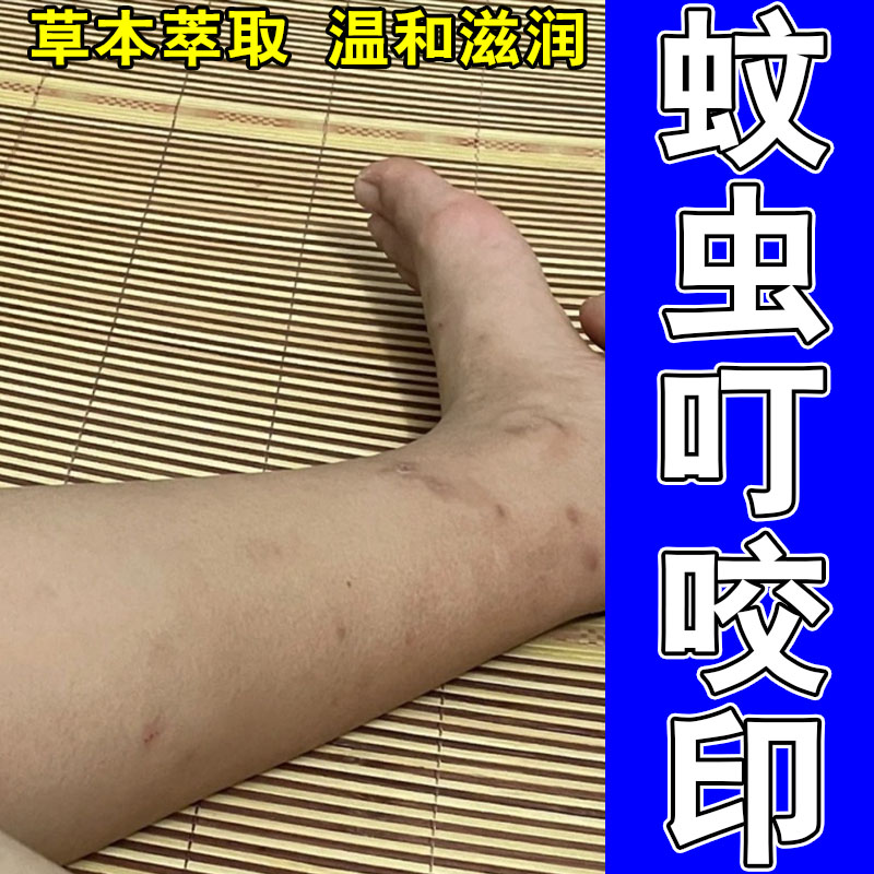 蚊虫抓挠造成皮肤暗沉深色黑印黑斑植物配方修护温和按摩膏