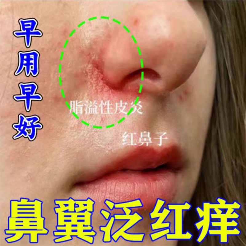 鼻子两边红痒干燥起皮抑菌止痒膏