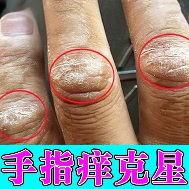 治手指关节痒膏药手指头长硬疙瘩手指垫真菌感染手掌起水泡脱皮药,保健用品,皮肤消毒护理（消）,淘宝优惠券,粉丝福利购,淘宝优惠卷
