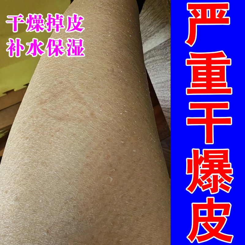 腿上皮肤干燥起皮屑换季全身干痒粗糙干燥保修复润肤甘油