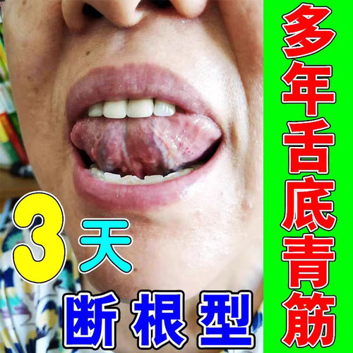 舌下青筋黑紫粗血管堵塞抑菌喷剂