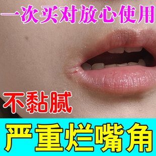 烂嘴角药膏唇炎嘴唇疱疹糜烂上火口角炎出血嘴巴干裂脱皮红肿结痂